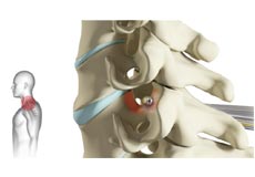 Cervical Foraminotomy