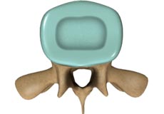 Discectomy