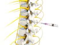 Epidural Steroid Injection (ESI)