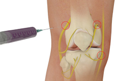 Genicular Nerve Block