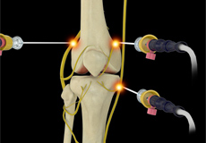 Genicular Radiofrequency Ablation