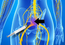 Superior/Inferior Hypogastric Plexus Block