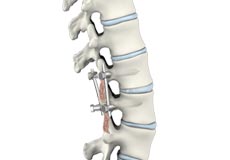 Posterior Lumbar Interbody Fusion (PLIF)