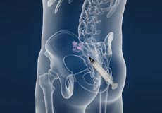 Sacroiliac (SI) Joint Injection