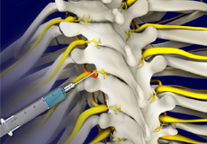 Selective Nerve Root Injection