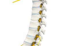 Spinal Fusion