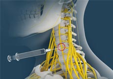  Stellate Ganglion Block