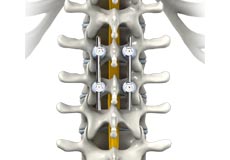 Thoracic Spinal Fusion