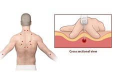 Trigger Point Injection